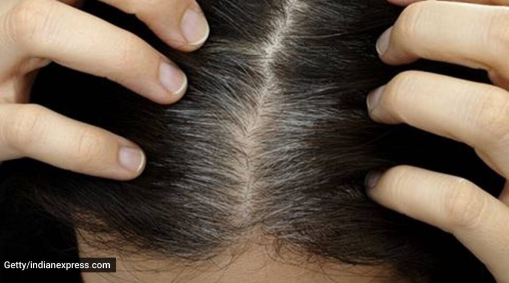 Expert shares effective Ayurvedic remedies to reverse premature greying of hair