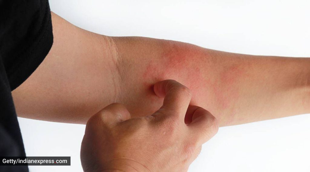 Winter rash: Why you get it, and how to treat it effectively